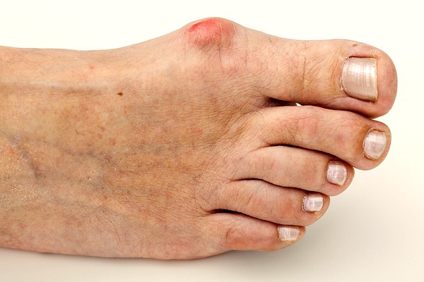 foot-problems-bunions Botox Foot Treatment